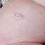5. Roseola Pictures