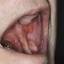 16. Pemphigus Mouth Pictures