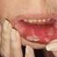 17. Pemphigus Mouth Pictures