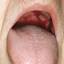 19. Pemphigus Mouth Pictures