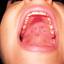 2. Pemphigus Mouth Pictures