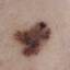 1. Early Signs of Skin Cancer Pictures
