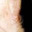 11. Early Signs of Skin Cancer Pictures