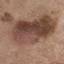15. Early Signs of Skin Cancer Pictures