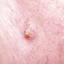 5. Early Signs of Skin Cancer Pictures