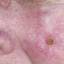 9. Early Signs of Skin Cancer Pictures
