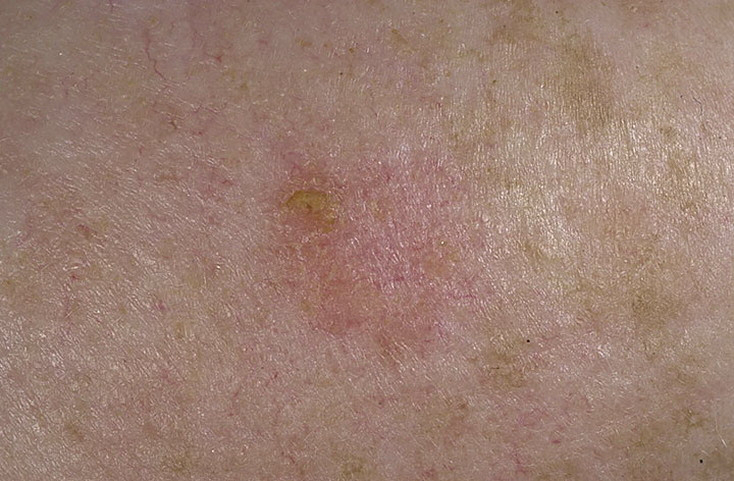 Early Signs Of Skin Cancer Pictures 15 Photos Images Illnessee Com   8 