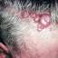 1. Skin Cancer on Scalp Pictures