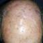 15. Skin Cancer on Scalp Pictures