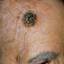 16. Skin Cancer on Scalp Pictures