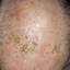 18. Skin Cancer on Scalp Pictures