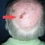 5. Skin Cancer on Scalp Pictures