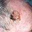 6. Skin Cancer on Scalp Pictures