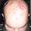 9. Skin Cancer on Scalp Pictures