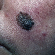 Skin Cancer on Face