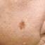 14. Skin Cancer on Face Pictures