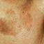 15. Skin Cancer on Face Pictures