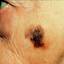 18. Skin Cancer on Face Pictures