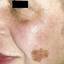 2. Skin Cancer on Face Pictures