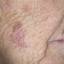 24. Skin Cancer on Face Pictures
