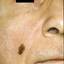 3. Skin Cancer on Face Pictures