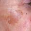 32. Skin Cancer on Face Pictures