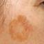 6. Skin Cancer on Face Pictures