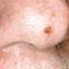 9. Skin Cancer on Face Pictures