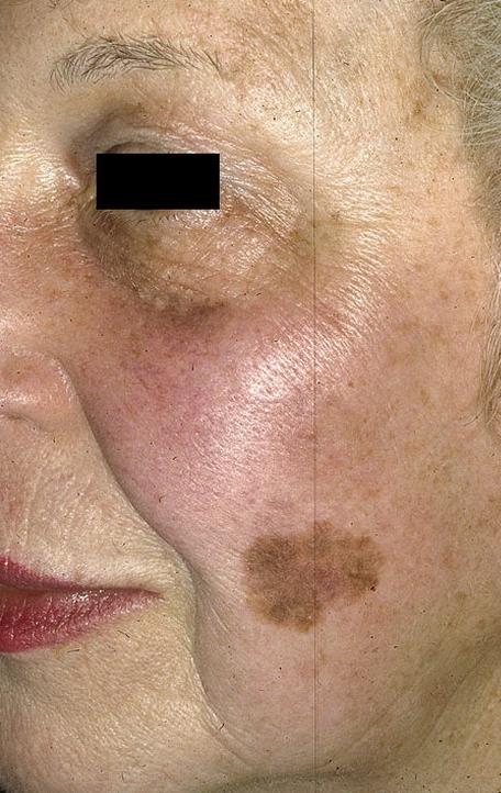 Skin Cancer On Face Pictures 33 Photos Images Illnessee