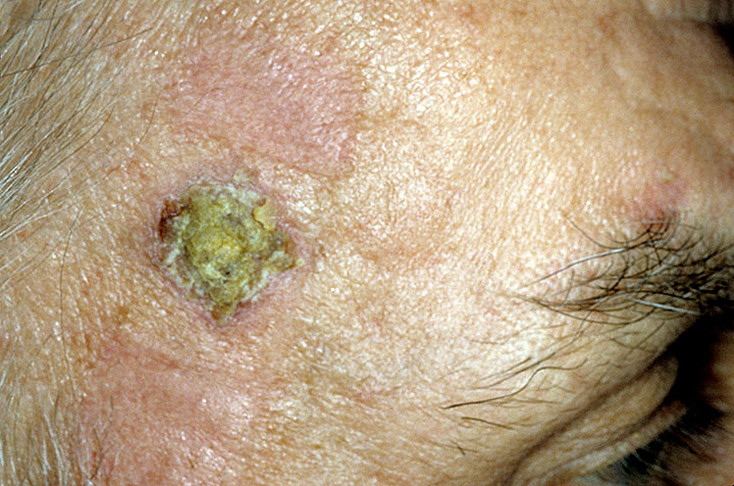 Skin Cancer Scars On Face