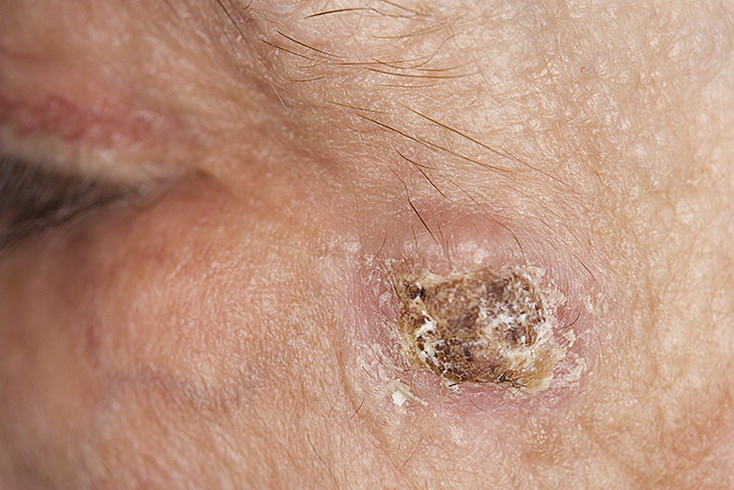 Skin Cancer Spots On Face All In One Photos