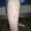 1. Skin Cancer on Leg Pictures