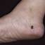 11. Skin Cancer on Leg Pictures