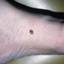 12. Skin Cancer on Leg Pictures