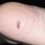 14. Skin Cancer on Leg Pictures