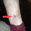 22. Skin Cancer on Leg Pictures
