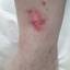 4. Skin Cancer on Leg Pictures