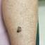 5. Skin Cancer on Leg Pictures