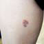 6. Skin Cancer on Leg Pictures