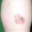 7. Skin Cancer on Leg Pictures
