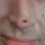 10. Skin Cancer on Nose Pictures
