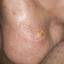 3. Skin Cancer on Nose Pictures
