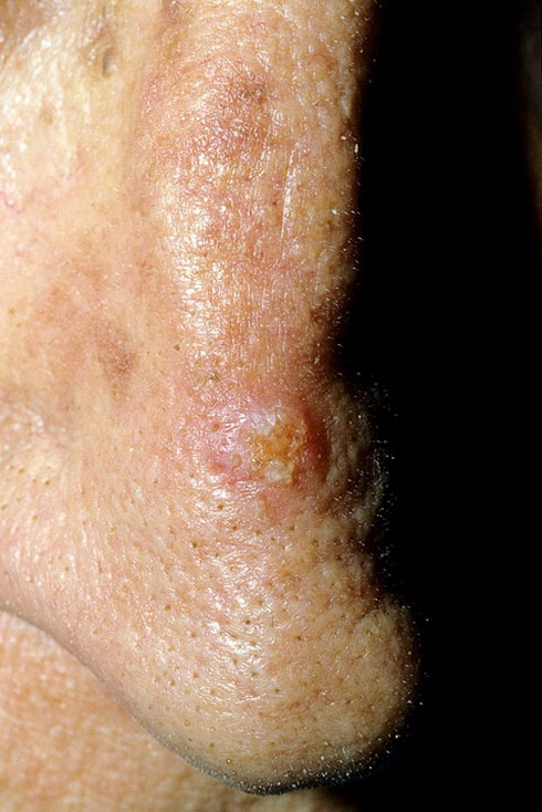 Skin Cancer on Nose Pictures – 12 Photos & Images / illnessee.com