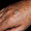 10. Skin Cancer on Hands Pictures