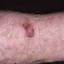 12. Skin Cancer on Hands Pictures