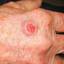 2. Skin Cancer on Hands Pictures