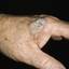 9. Skin Cancer on Hands Pictures