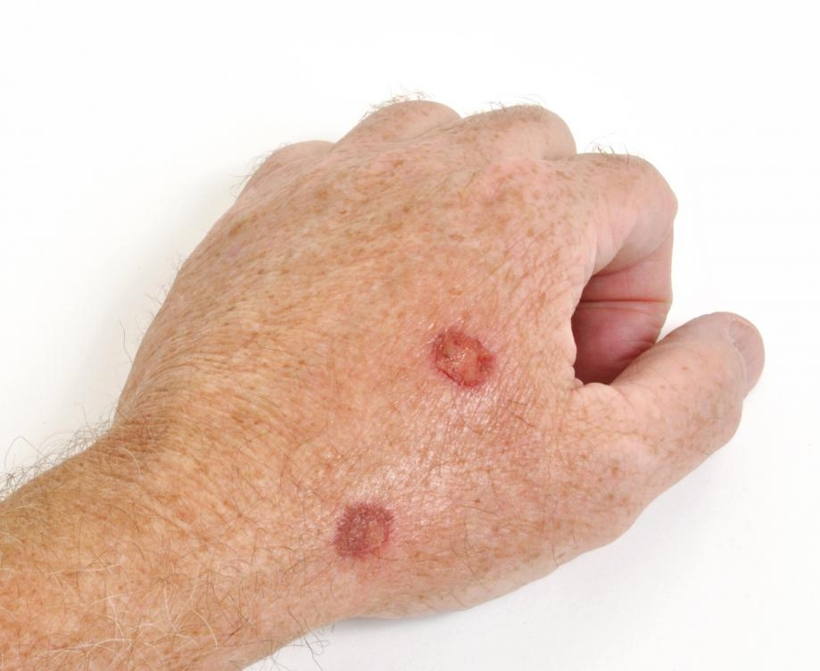 Skin Cancer on Hands Pictures - 16 Photos & Images ...