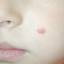 5. Skin Cancer in Children Pictures
