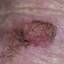 12. Skin Cancer Pictures